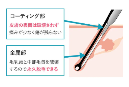 毛の生えた毛穴に脱毛用の細い器具を入れて電流を流すことで脱毛できる