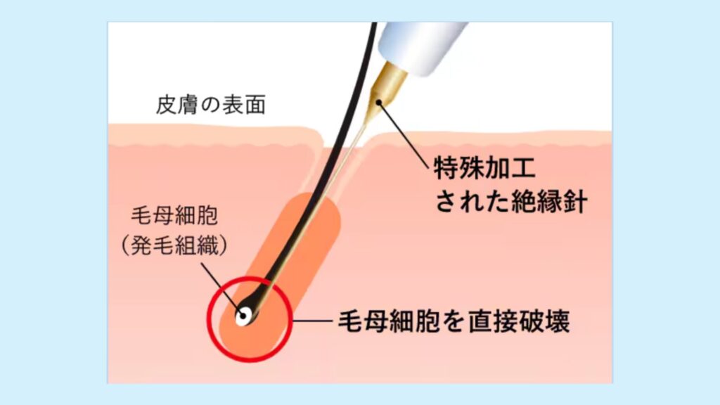 湘南美容クリニック、ニードル脱毛図解
