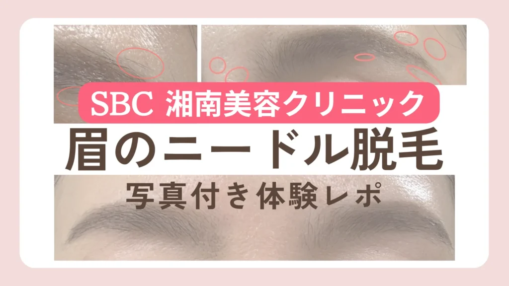 眉のニードル脱毛〜SBC湘南美容クリニック〜写真付き体験レポ