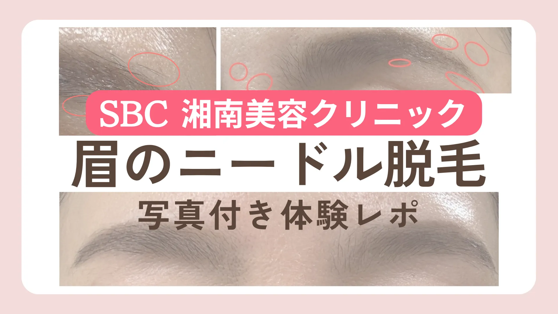 眉のニードル脱毛〜SBC湘南美容クリニック〜写真付き体験レポ