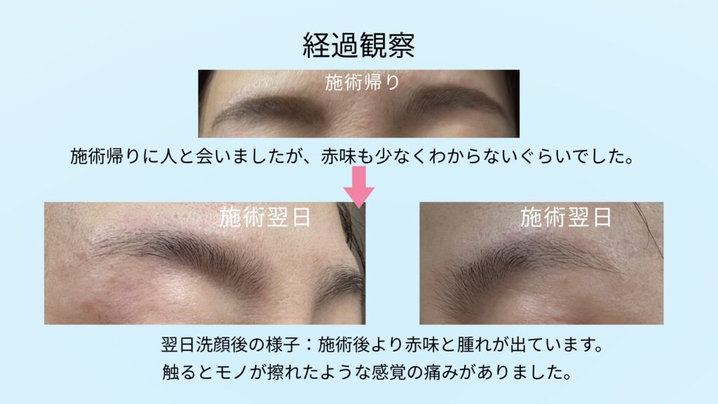眉のニードル脱毛経過観察
施術帰り：赤味も少なく、施術帰りに人と会いましたがわからないぐらい。
翌日：洗顔後の様子、施術後より赤味と腫れが出ています。触るとモノが擦れたような痛みがありました。