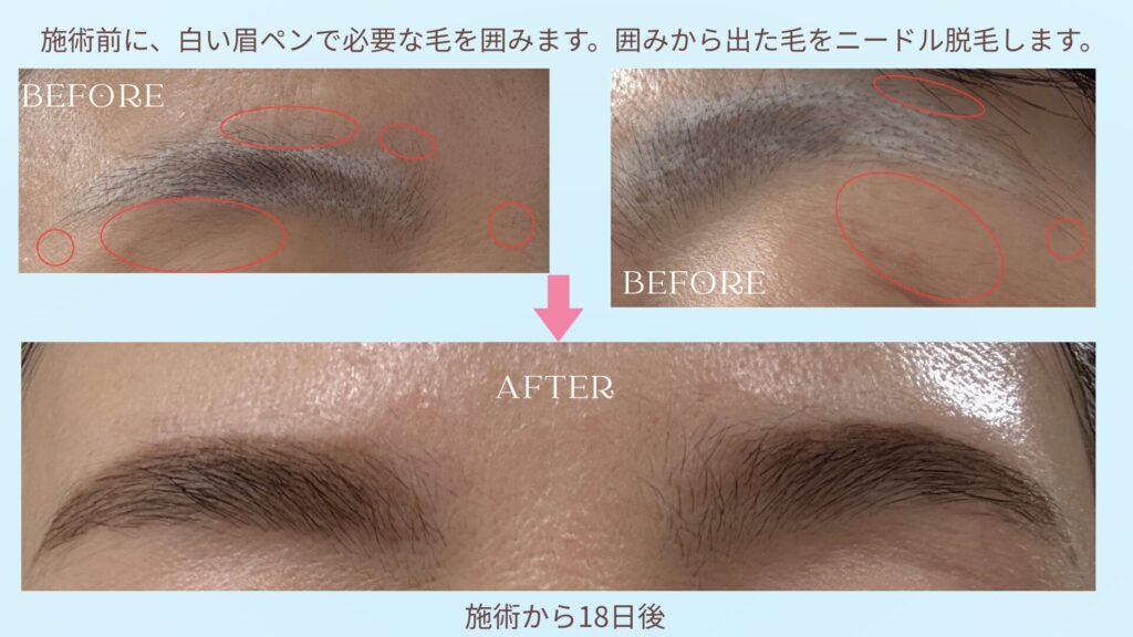 ニードル脱毛before&after写真
施術前に、白い眉ペンで必要な残す毛を囲みます。囲みから出た毛をニードル脱毛します。
Afterの写真は施術から１８日後で、余分な毛がなくなり眉周りがスッキリとしています。