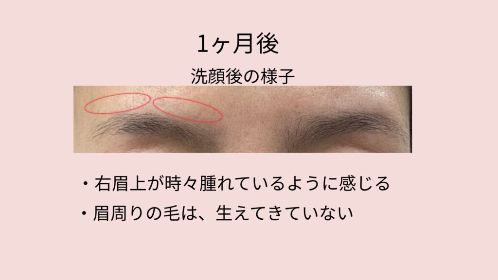 眉ニードル脱毛後の1ヶ月後の様子