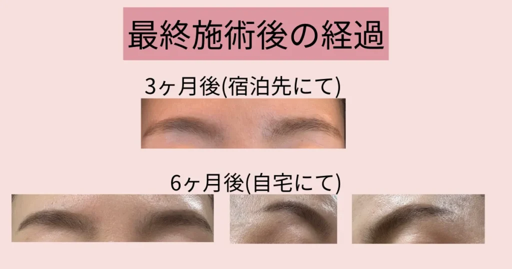 眉のニードル脱毛、最終施術から3か月後と6ヶ月後