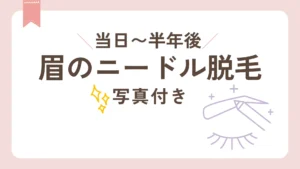 経過写真眉ニードル脱毛当日〜半年後まで