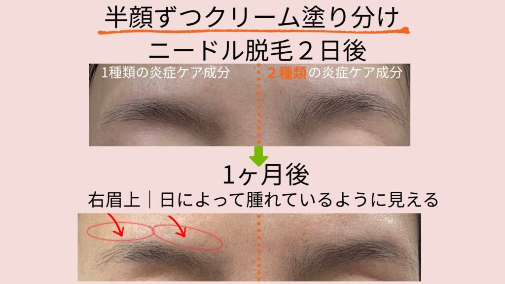 ニードル脱毛後の炎症ケア比較｜炎症ケア成分1種類と2種類を半顔ずつ塗り分け、2日後と1ヶ月後の経過
炎症ケアが2種類しっかり入っている方は腫れが収まっているのに対し、炎症成分1種類の方は、日によって眉上が腫れているように見える。