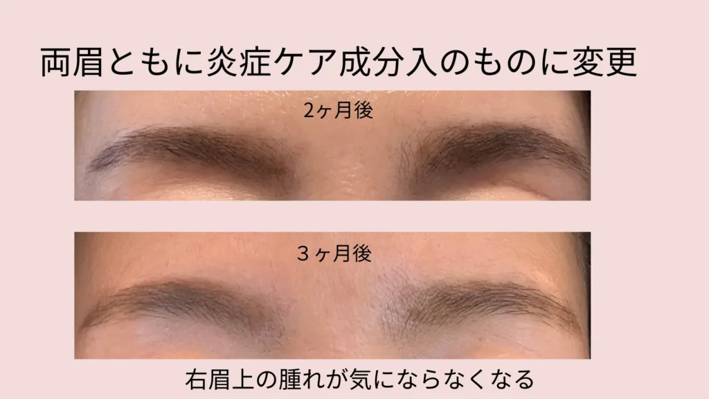 両眉ともに、2種類の炎症ケア成分有りのものをさらに一ヶ月塗り続けたところ、2ヶ月後3ヶ月後ともに、気になっていた右眉上の腫れがなくなった。