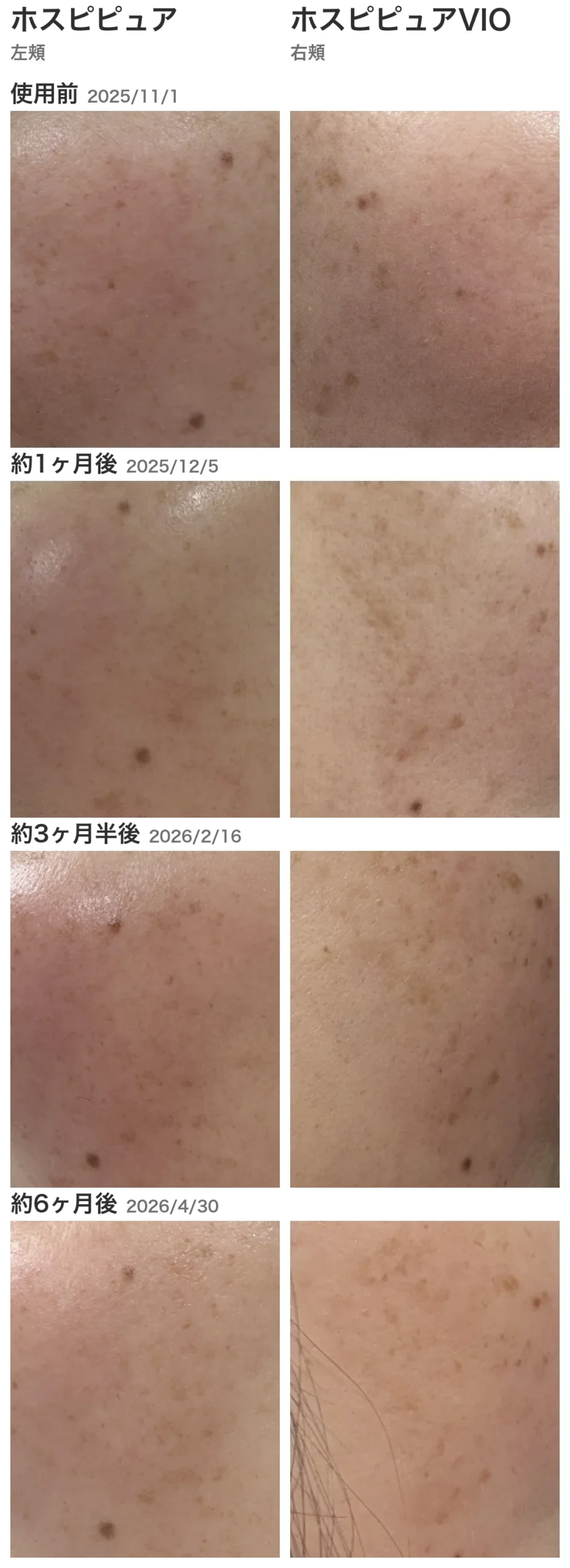 ホスピピュア(左頬)とホスピピュアVIO(右頬)の使用前・約1ヶ月後・約3ヶ月半後・約6ヶ月後の経過写真