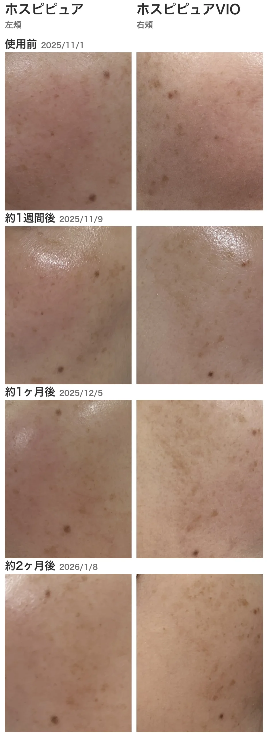 ホスピピュアとホスピピュアVIOの経過写真(使用前・約1週間後・約1ヶ月後・約2ヶ月後)